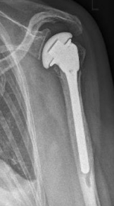 Proximaler Oberarmbruch10 Proximaler Oberarmbruch10