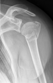 Proximaler Oberarmbruch5 Proximaler Oberarmbruch5