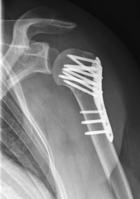 Proximaler Oberarmbruch6 Proximaler Oberarmbruch6