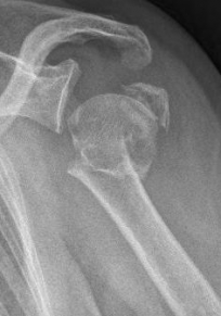 Proximaler Oberarmbruch9 Proximaler Oberarmbruch9