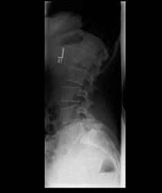 Spondylolisthese I Spondylolisthese I